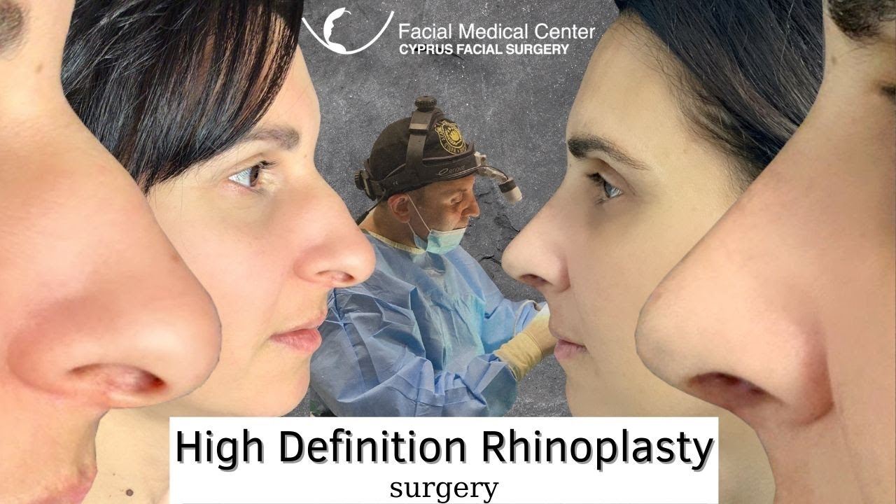 High Definition Rhinoplasty | Cyprus Facial Surgery