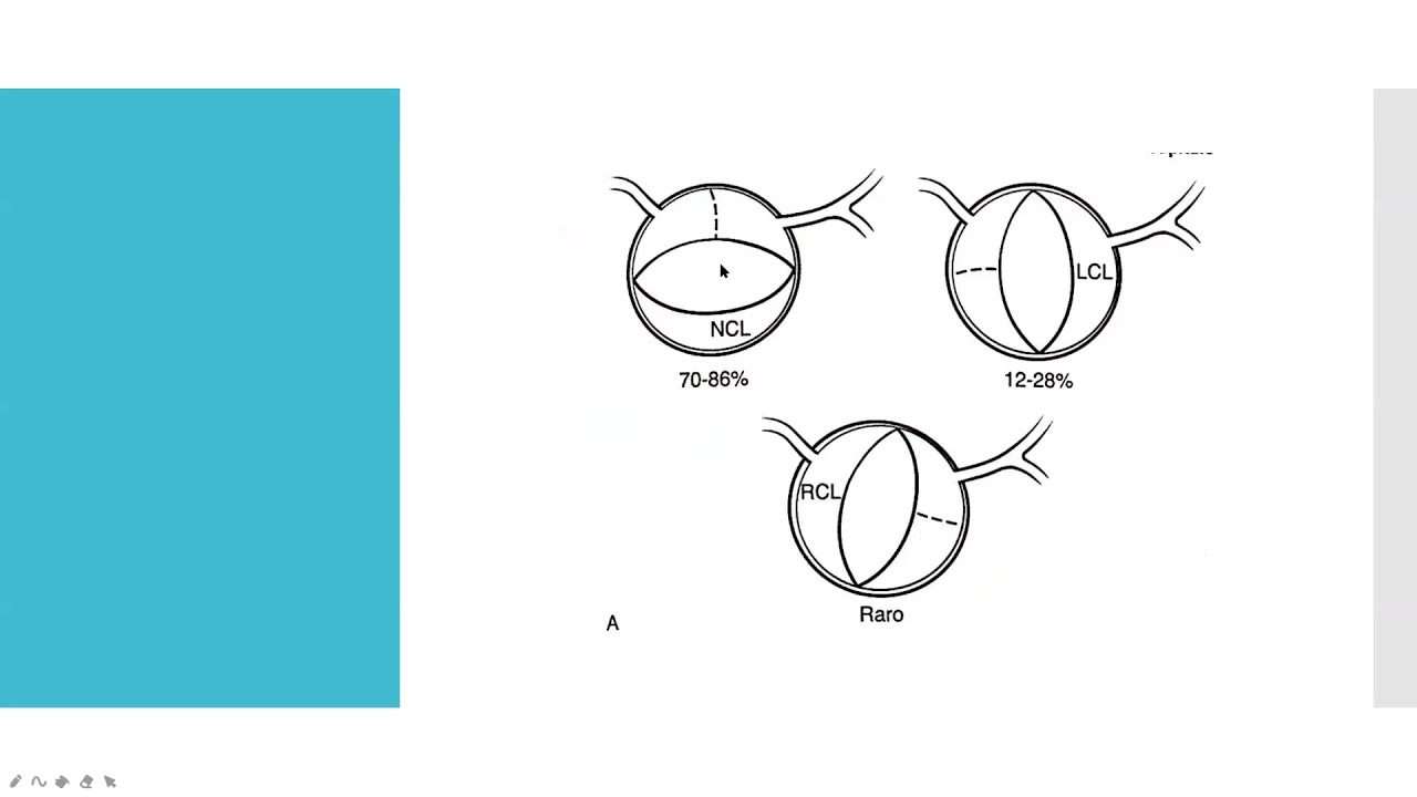 Ecocardiografía Estenosis Aórtica 1