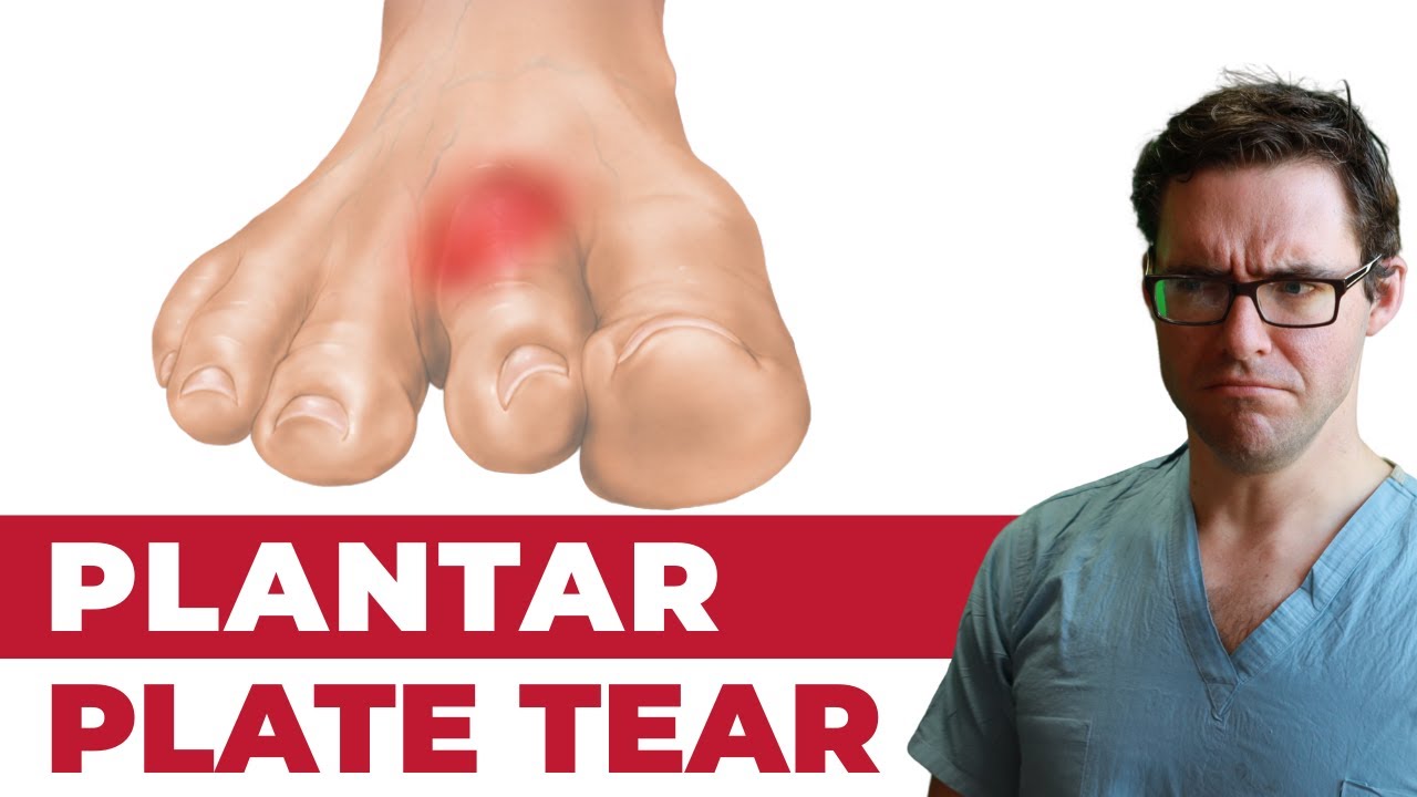 БОЛЬ на втором пальце ноги и разрыв подошвенной пластины [Наложение ленты и лучшее лечение!]