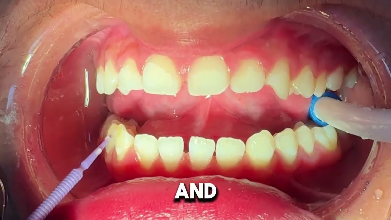 How do they put braces on? - 15 year old patient - Tooth Time Family Dentistry New Braunfels Texas