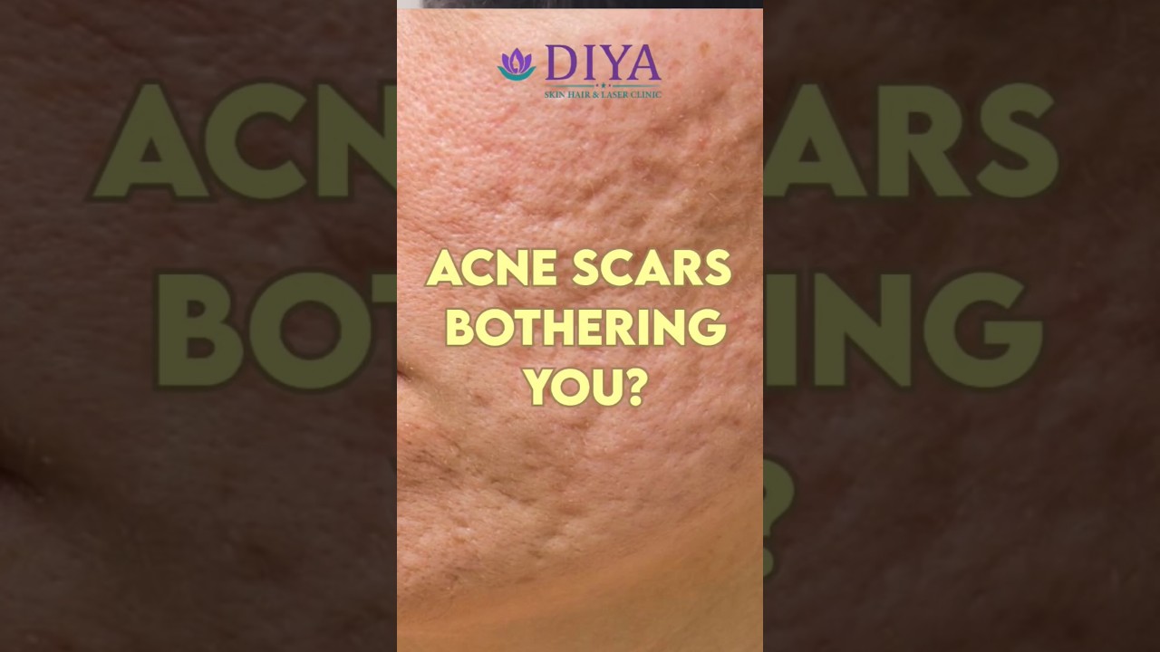 MNRF LASER for Acne scars treatment at DIYA SKIN HAIR LASER CLINIC NAGARAM 