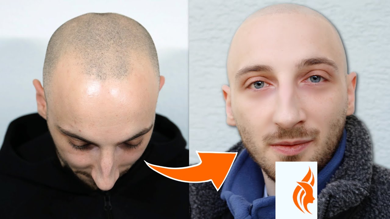 Haarpigmentierung: Flo’s Lebensverändernde Erfahrung | Von Haarausfall zu neuem Selbstbewusstsein!