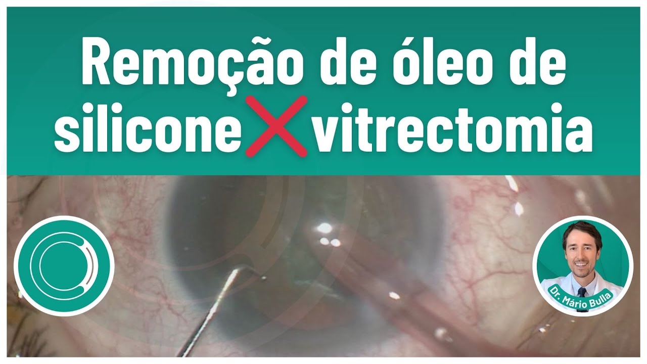 Remover &Oacute;leo de Silicone X Vitrectomia: Qual a diferen&ccedil;a??