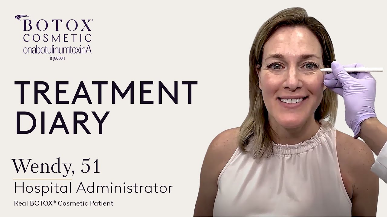 Wendy, 51 — BOTOX® Cosmetic Treatment Diary