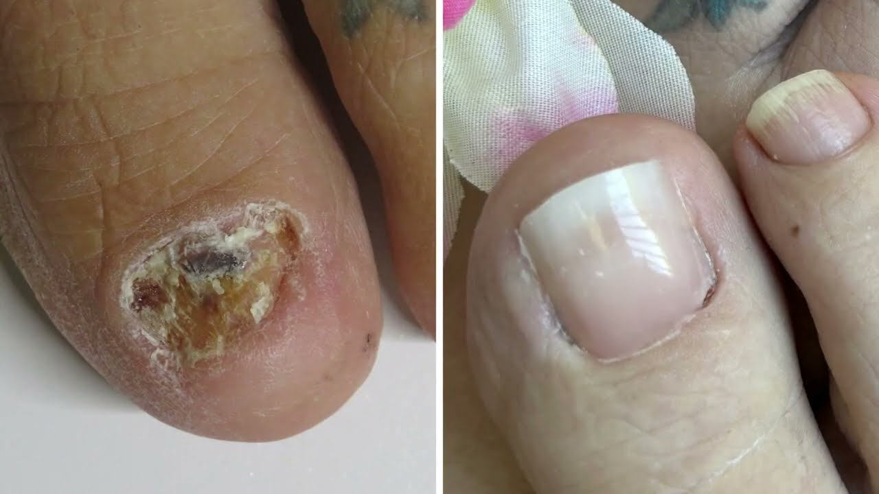 From Icky Toes to Pretty Summer Toes ! Here's How