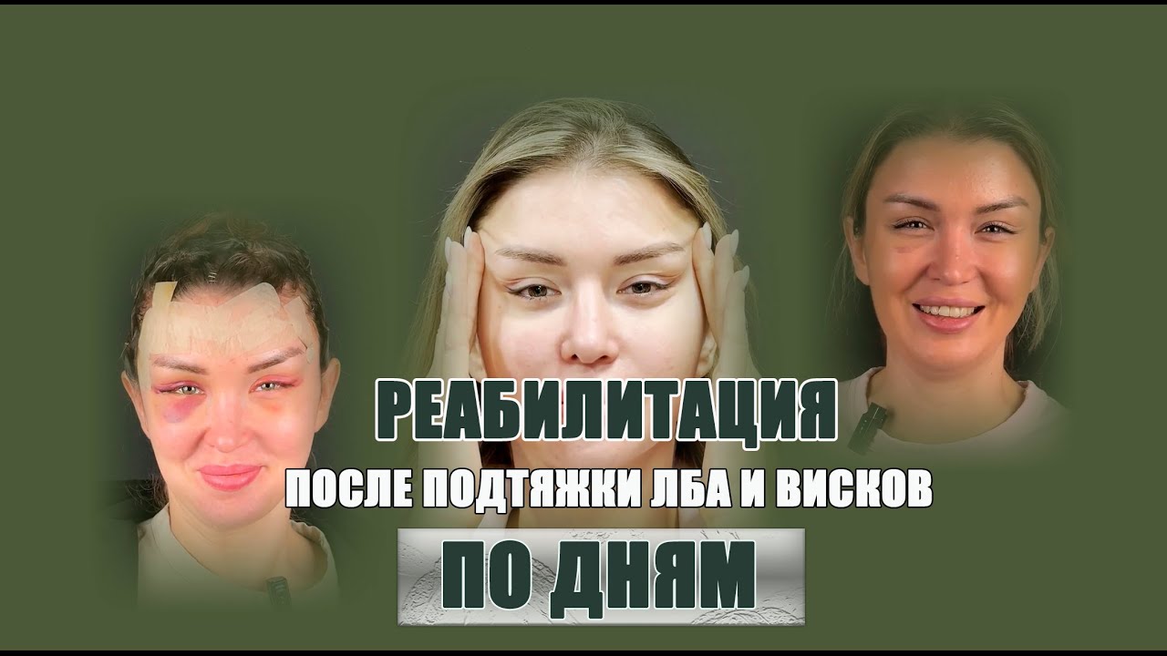 Лобно-височный лифтинг: 14 дней изменений