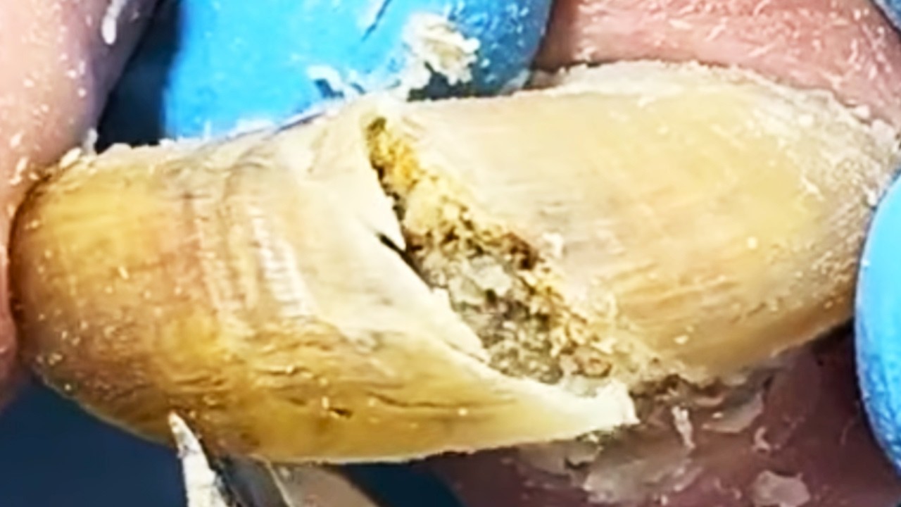 Extremely Long Toenails, How Long Has It Been Since They Were Cut【Podiatry Clinic】