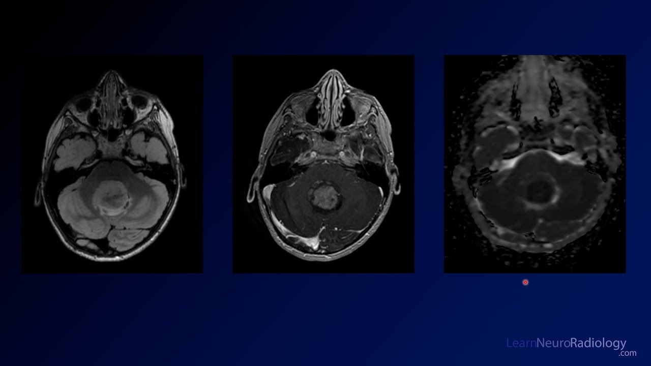Neuroradiology Board Review - Brain Tumors - Case 10