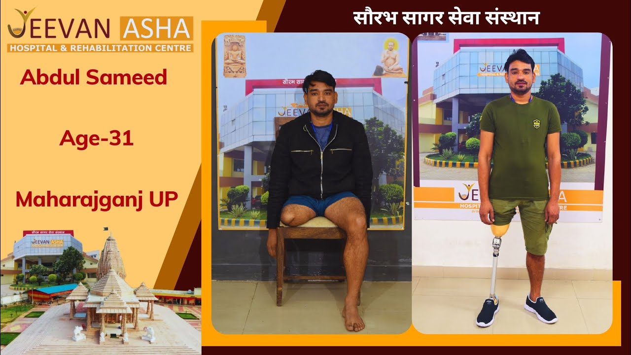 Abdul lost right leg in a accident Jeevan Asha Hospital provided him free of cost Modular Prosthesis