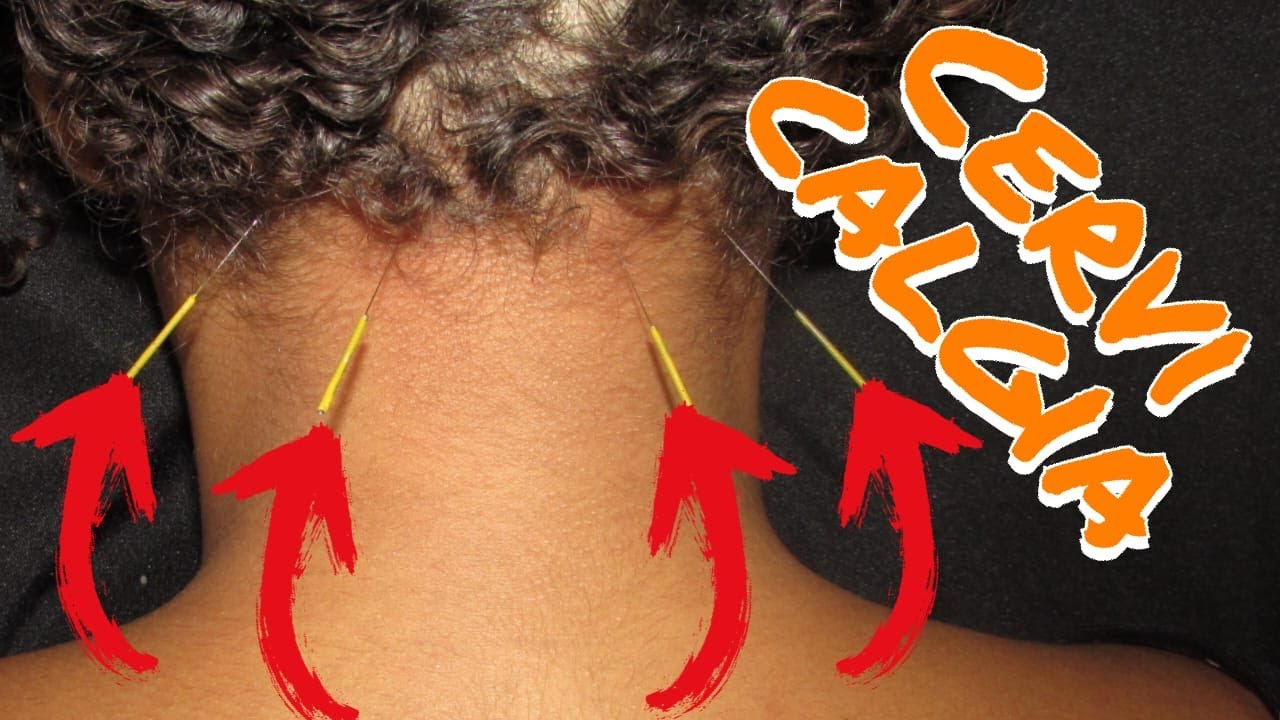 Cervicalgia - Como Tratar com Acupuntura