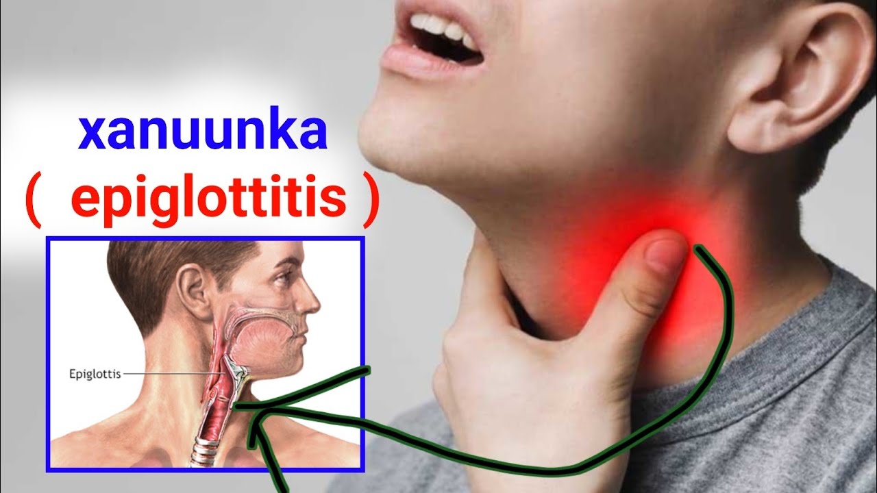 Xanuunka dhuunta iyo xuubka daboola Hawa mareenka ee (  epiglottis )