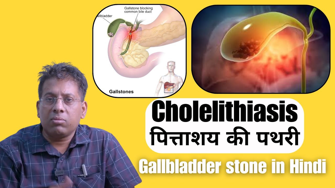 Cholelithiasis - पित्ताशय की पथरी - लक्षण, कारण और उपचार | Gallbladder stone in Hindi