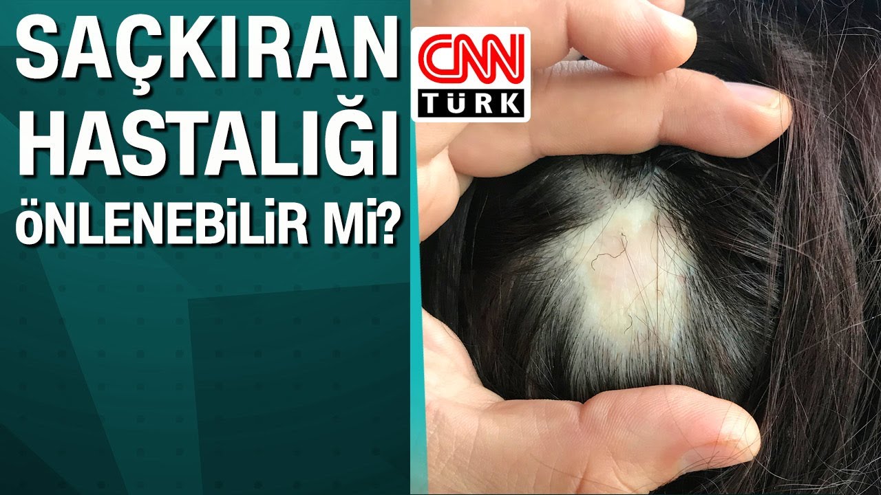 Saçkıran hastalığı önlenebilir mi?