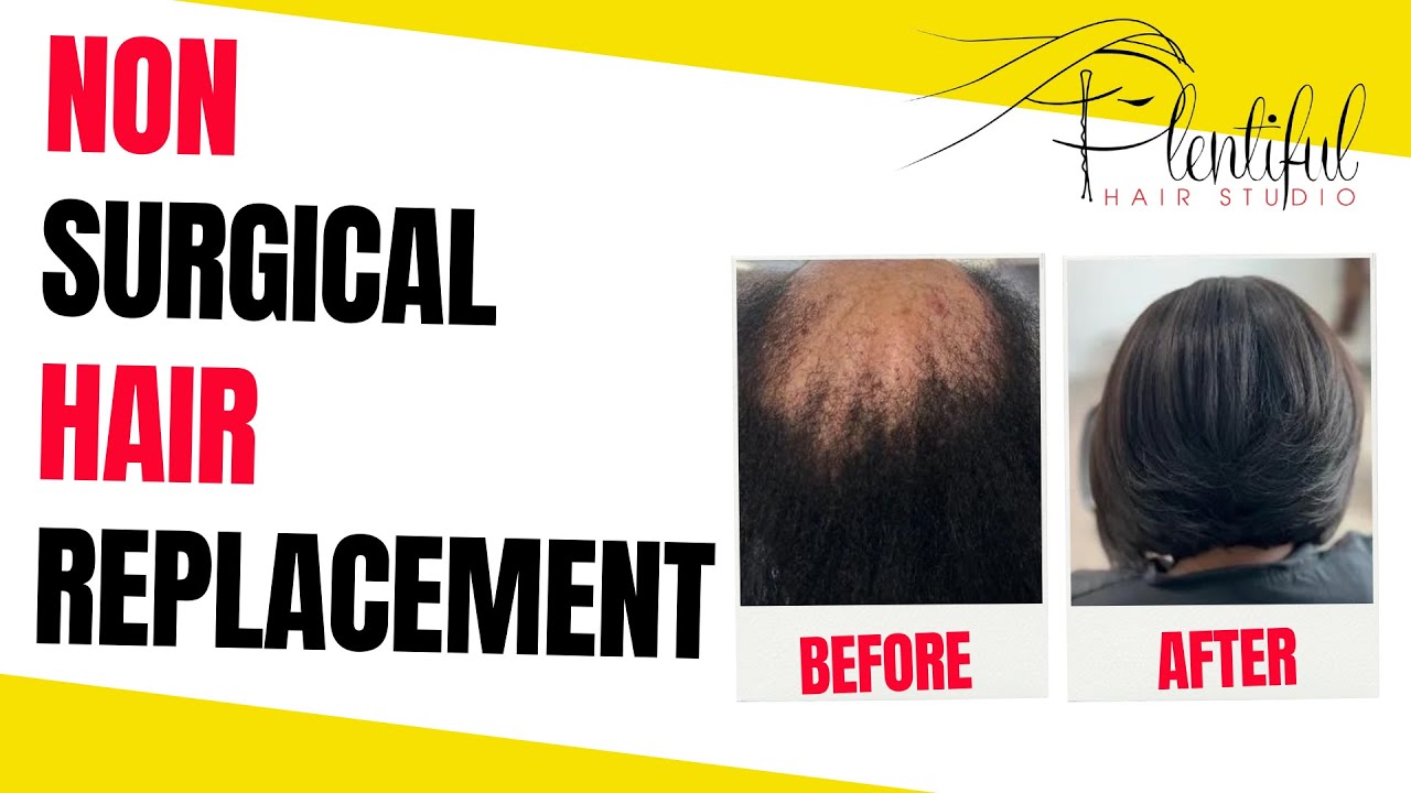 Non-surgical hair replacement | Hair loss treatment | Process For Non-Surgical Hair Replacement