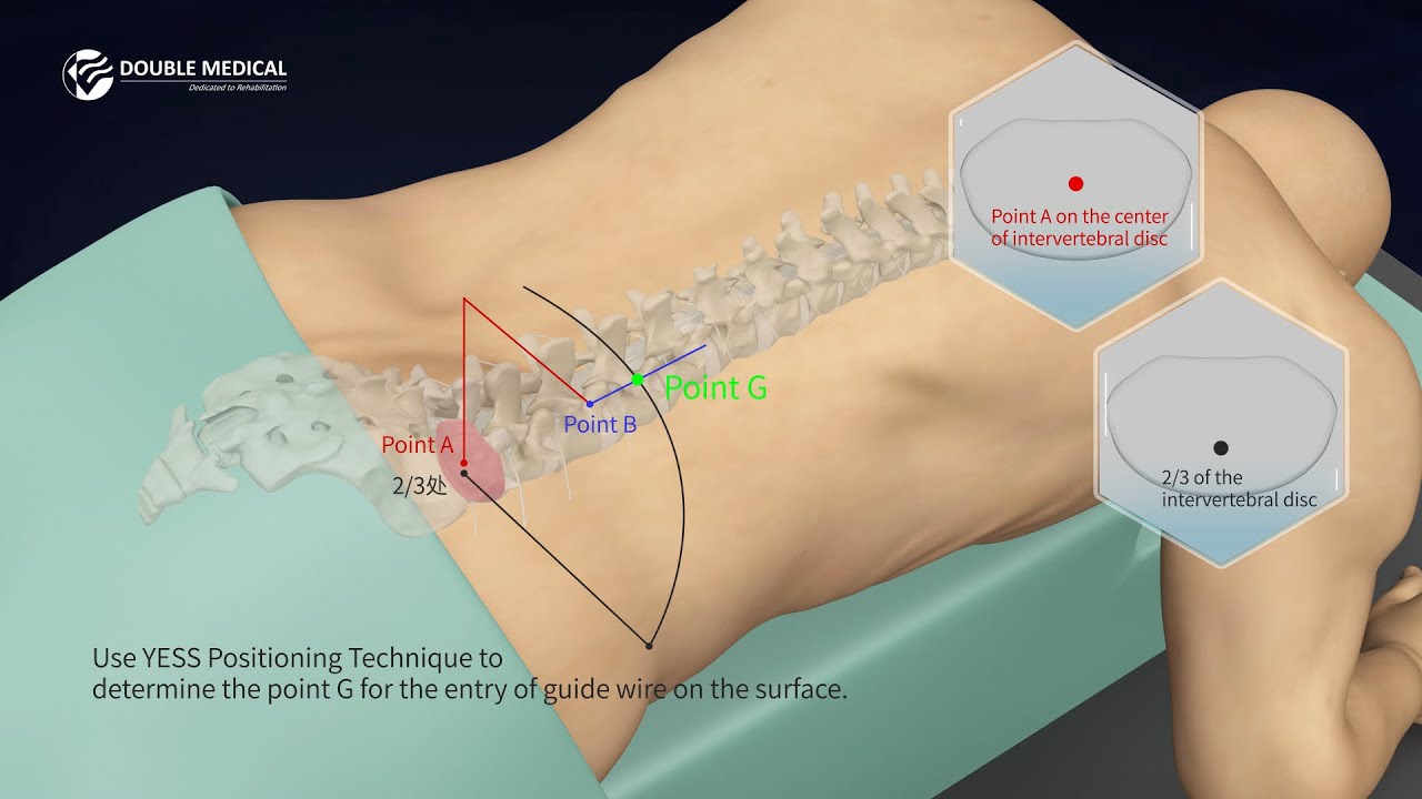 Endoscopic Transforaminal Lumbar Interbody Fusion Surgery With Double Medical Endo LIF Cage System