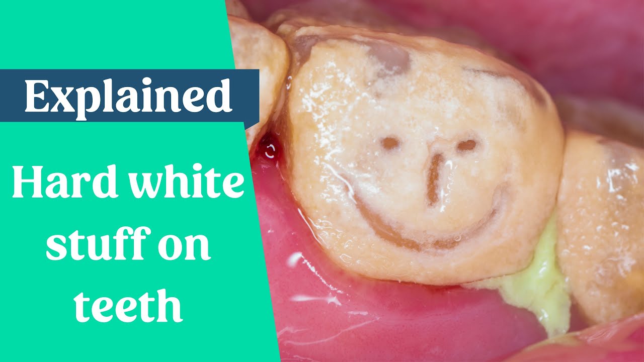 What’s the hard white stuff on my teeth?