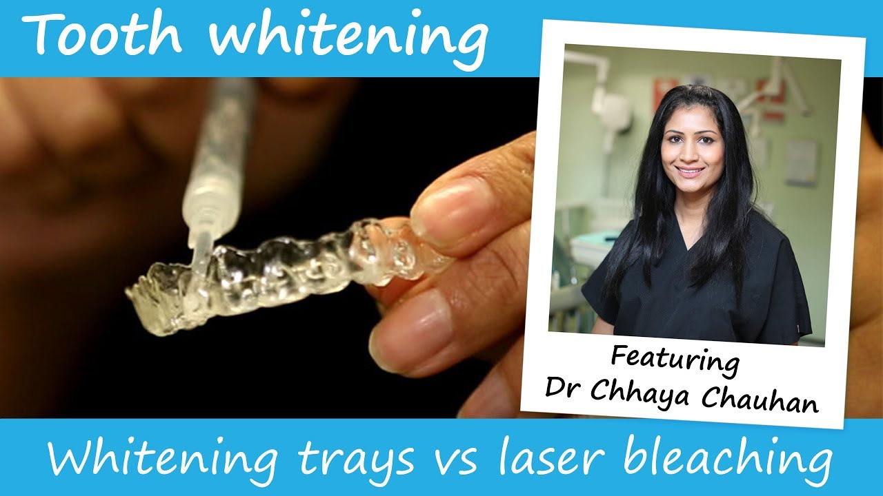 Professional teeth whitening trays vs laser whitening