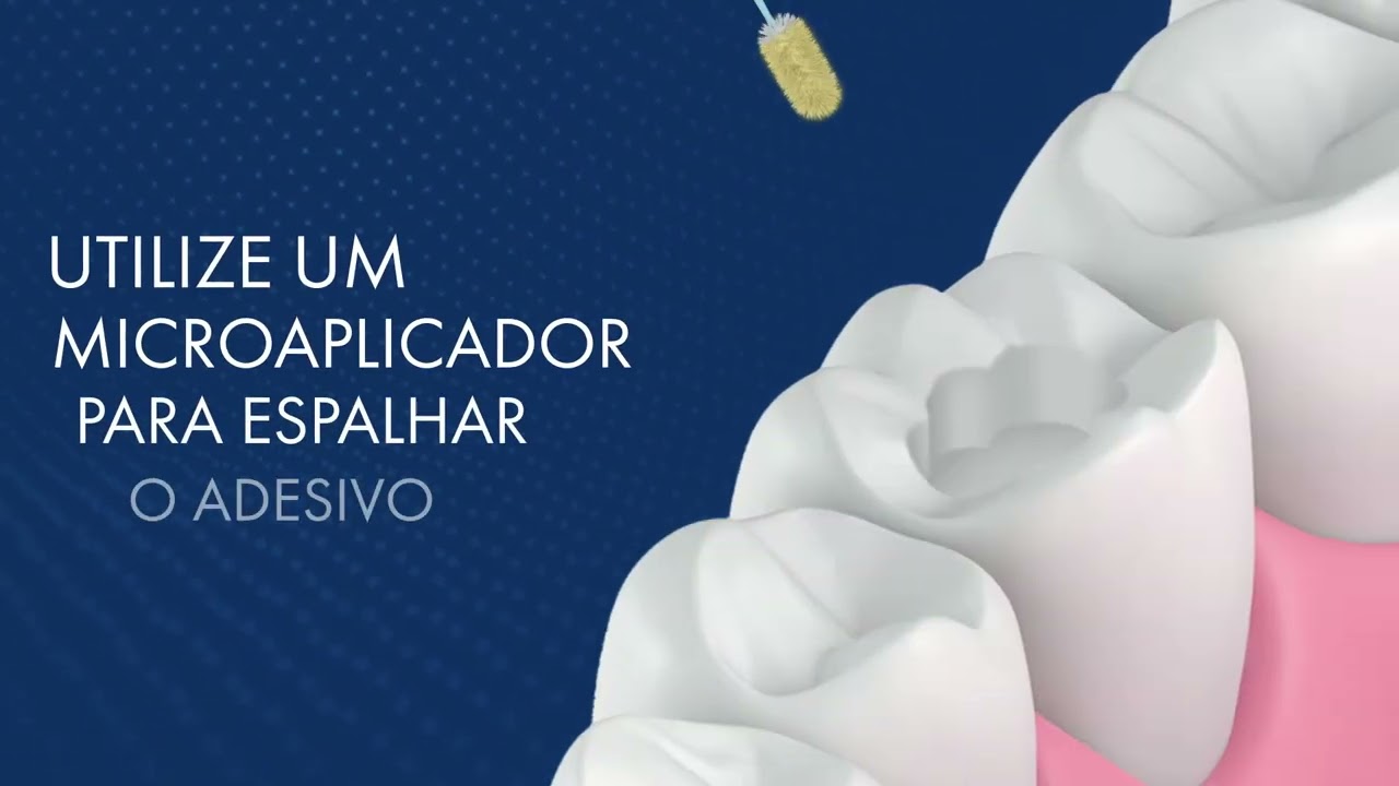Adesivo universal em odontologia | Protocolo clínico de aplicação