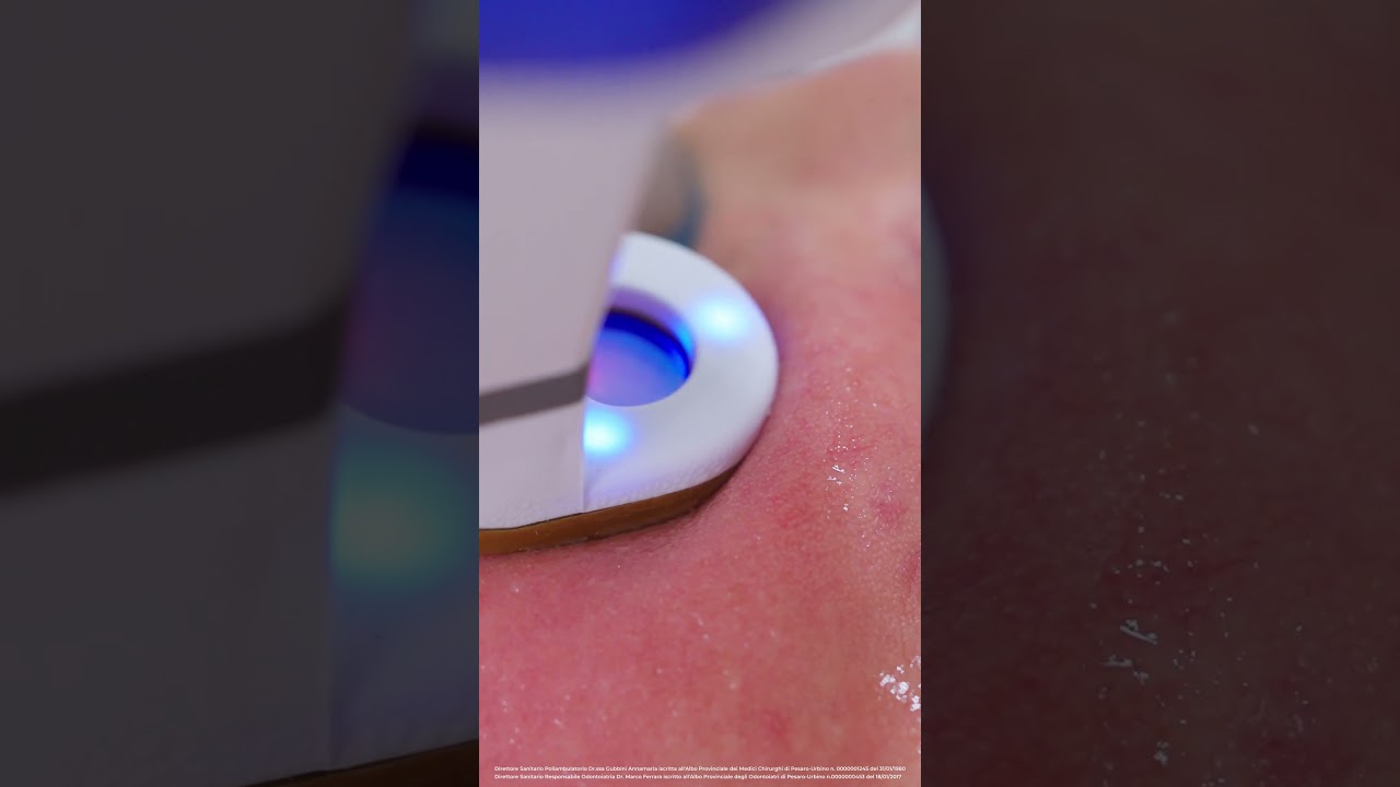 Trattamento Acne con AviClear #acne #dermatologia