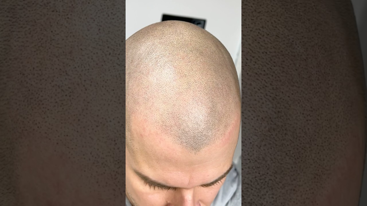 How Natural is SMP? #scalpmicropigmentation