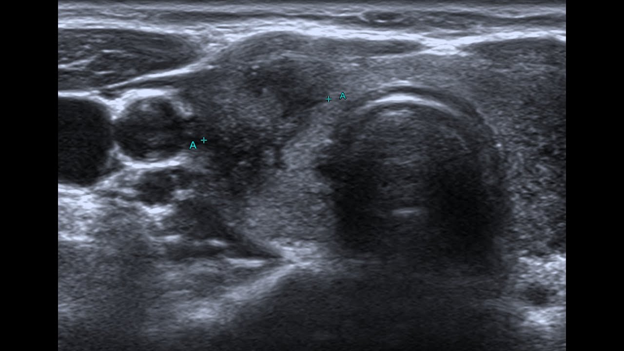 Thyroid diffuse disease Vs nodular disease