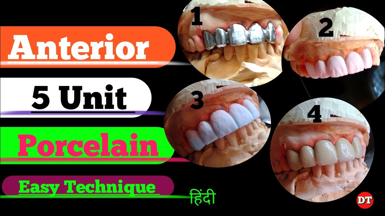 Anterior 5 unit Porcelain| How to Build up ceramic| Laboratory| Anatomy| Human Tooth| Ceramic| Lab