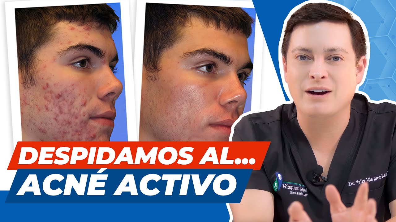 Todo lo que debes saber del acné activo