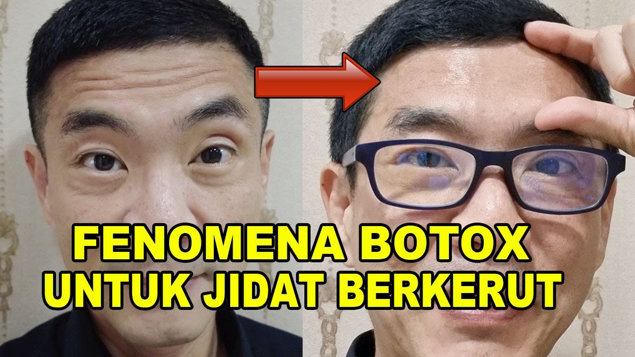 Fenomena Botox Untuk Jidat Berkerut