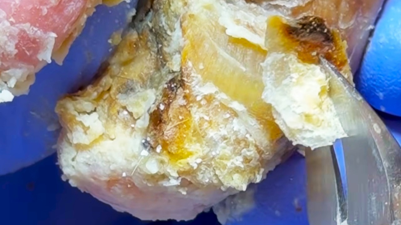 The toenails are gradually covered with fungus and are slowly removed【Dr. Liu's Pedicur】