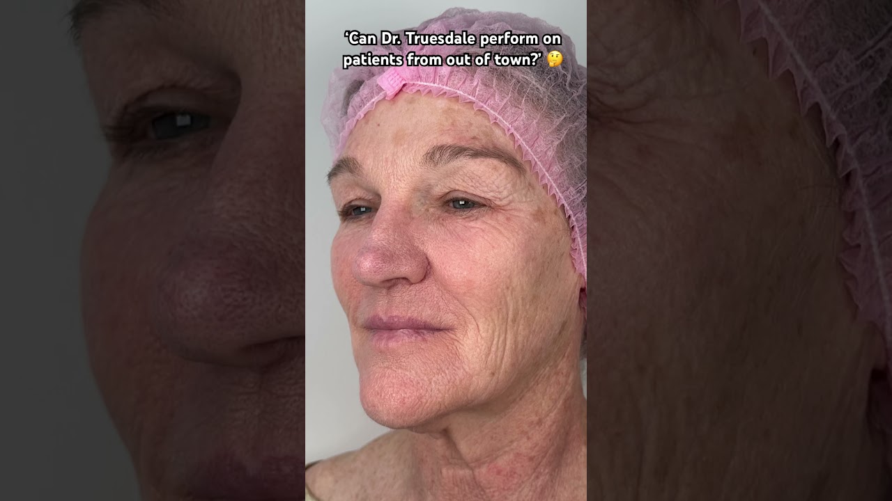 🤩 Beautiful results from our patient from Texas! #facelift #drtruesdale #plasticsurgery #snatched