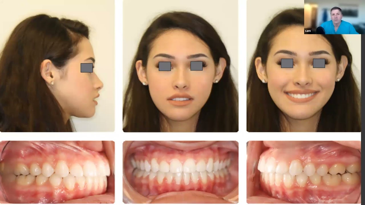My Midline is Off! Dealing with Maxillary Midline Discrepancies in Orthognathic Surgery.