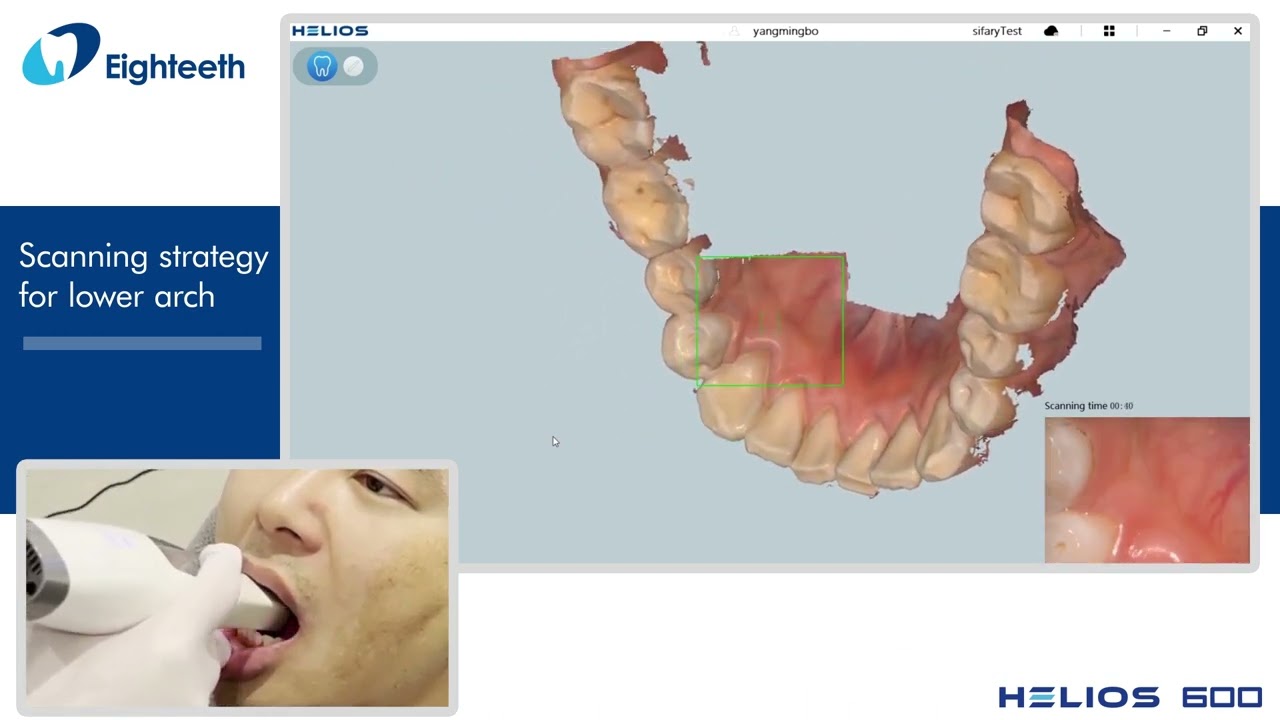 Eighteeth Helios 600 Intraoral Scanner Scanning Strategy for Lower Arch
