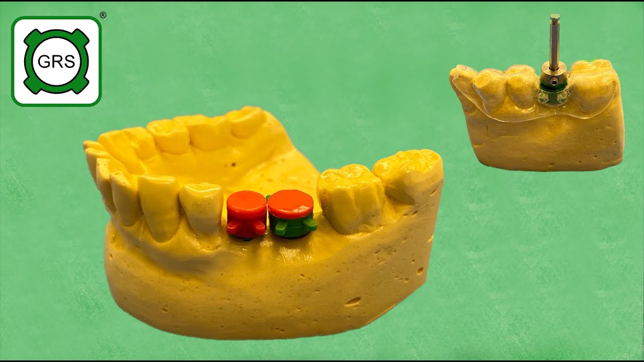 GRS Guide System - Vacuum-Formed Dental Implant Surgical Guide & Stone Diagnostic Model