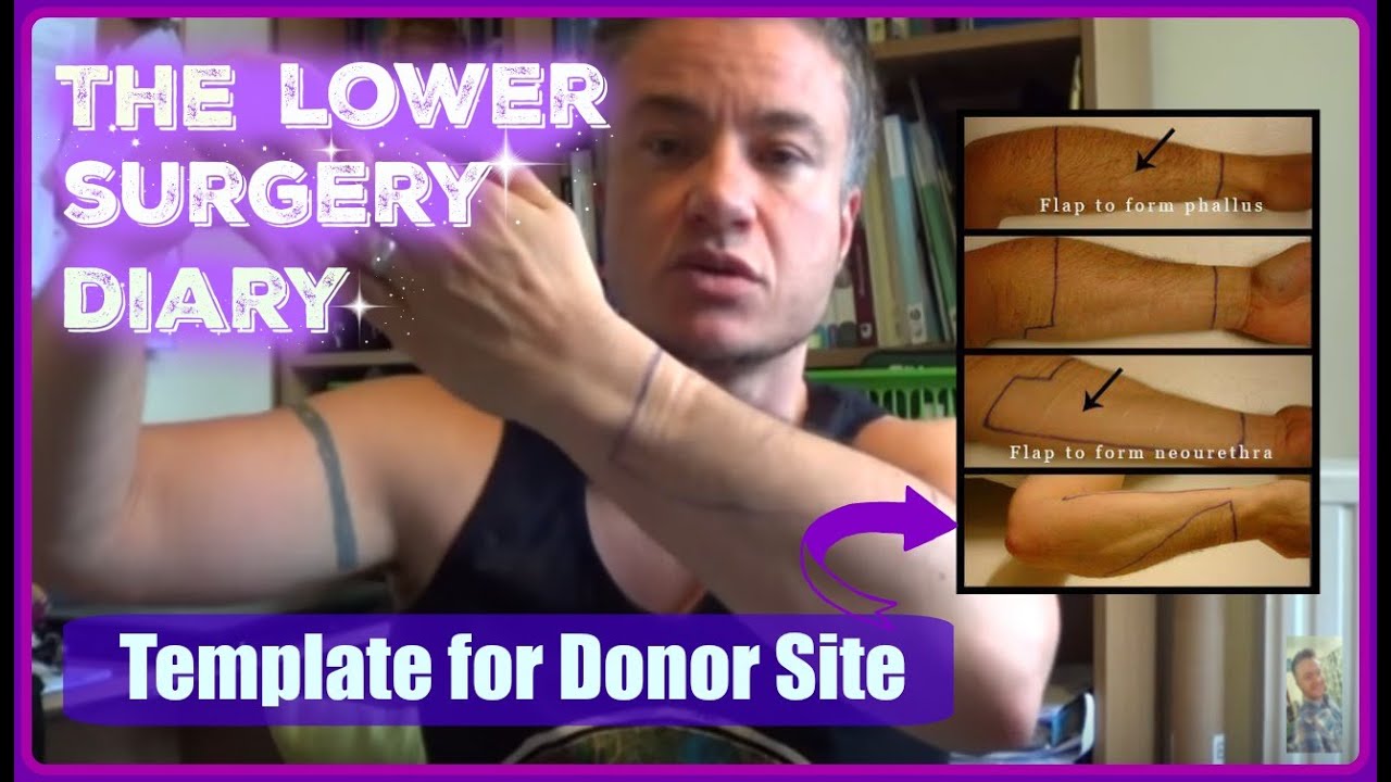 FTM Phallo | Forearm Graft Preparation