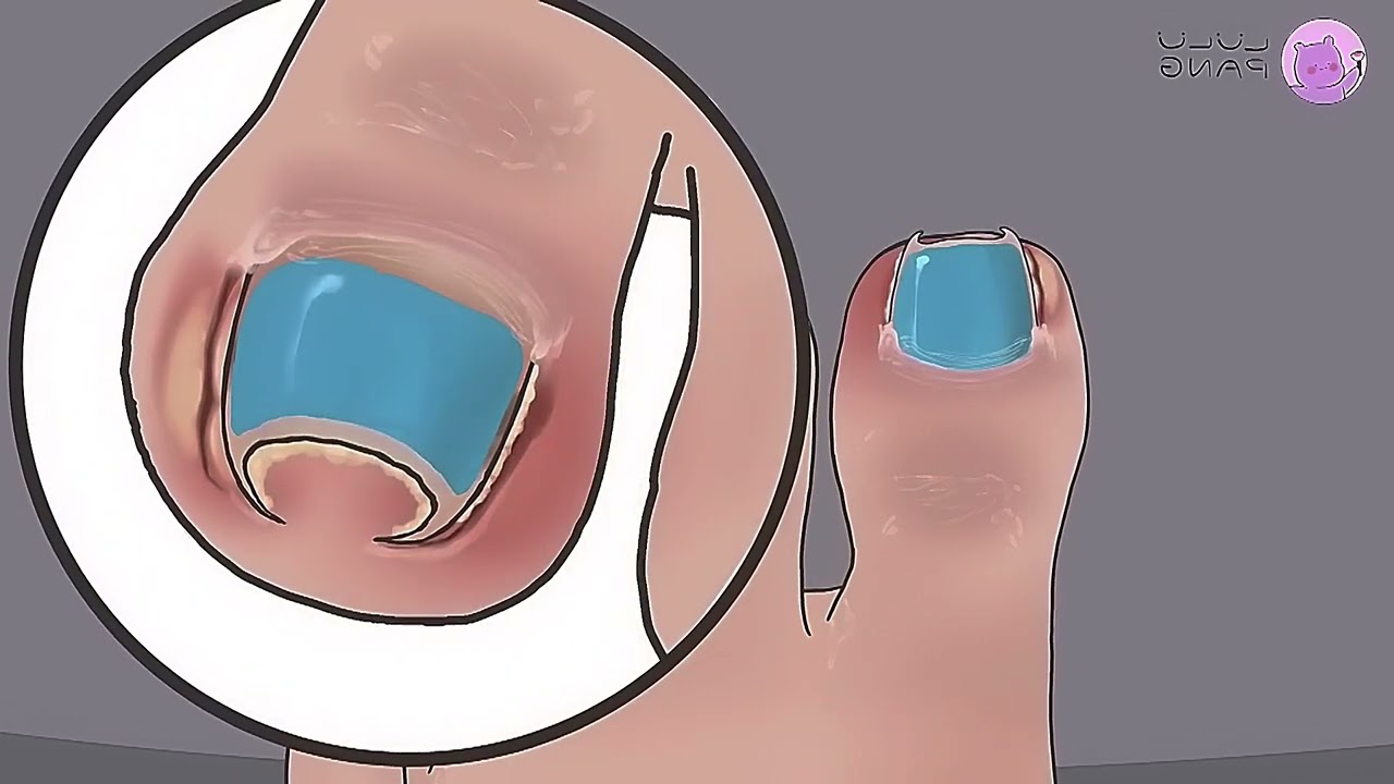 ASMR COMPILATION | INGROWN TOENAIL REMOVAL | TOENAIL CLEANING | DEEP CLEANING.