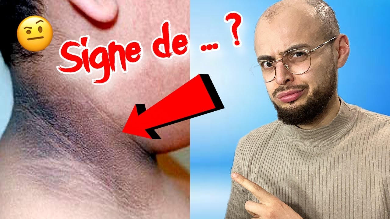 Pourquoi ça sur la peau ? Ep 2 : L'Acanthosis Nigricans