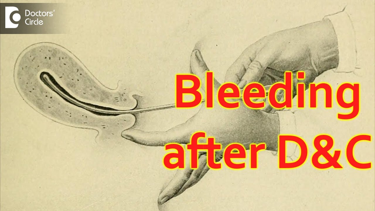 How many days do you bleed after a D&C? - Dr. Sagar Bumb of Cloudnine Hospitals | Doctors' Circle