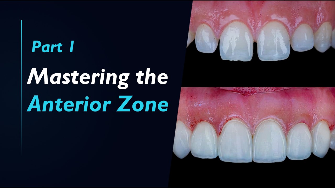 Mastering the Anterior Zone - Part 1/2 (Composite restoration on anterior teeth)