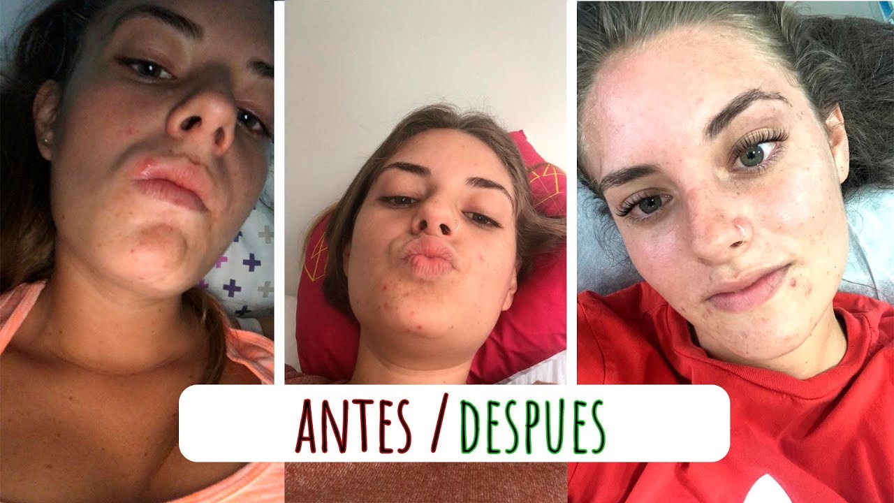 Rutina de Cuidado Facial Con Acne - Daniela Arango A