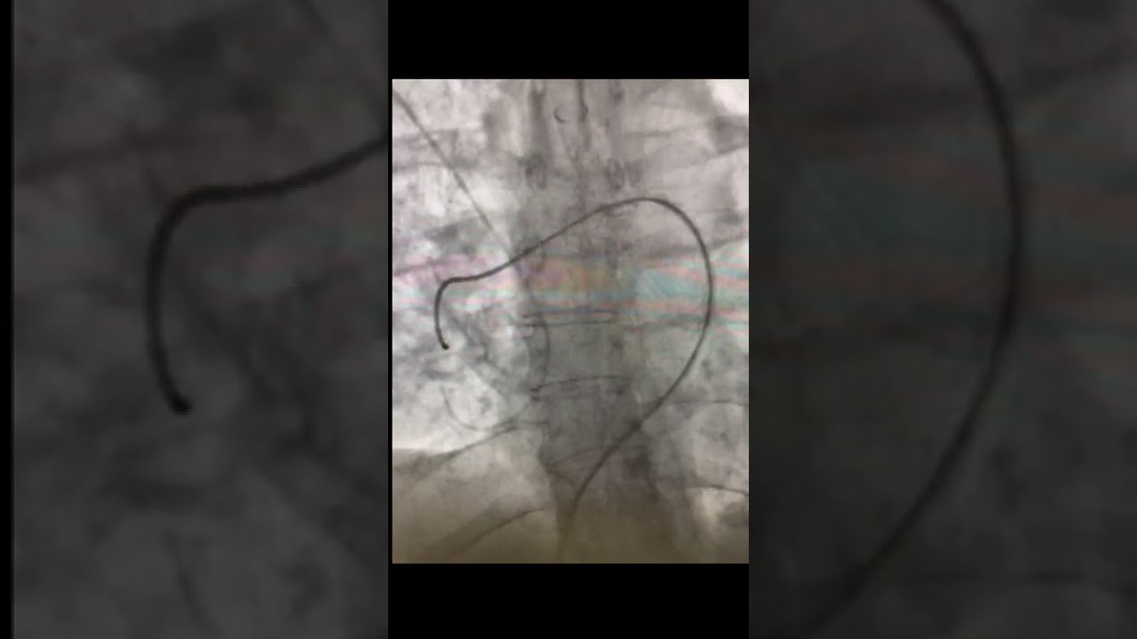 Dr. Lichaa: Tips to Access the Right Pulmonary Artery for Endovascular Pulmonary Interventions