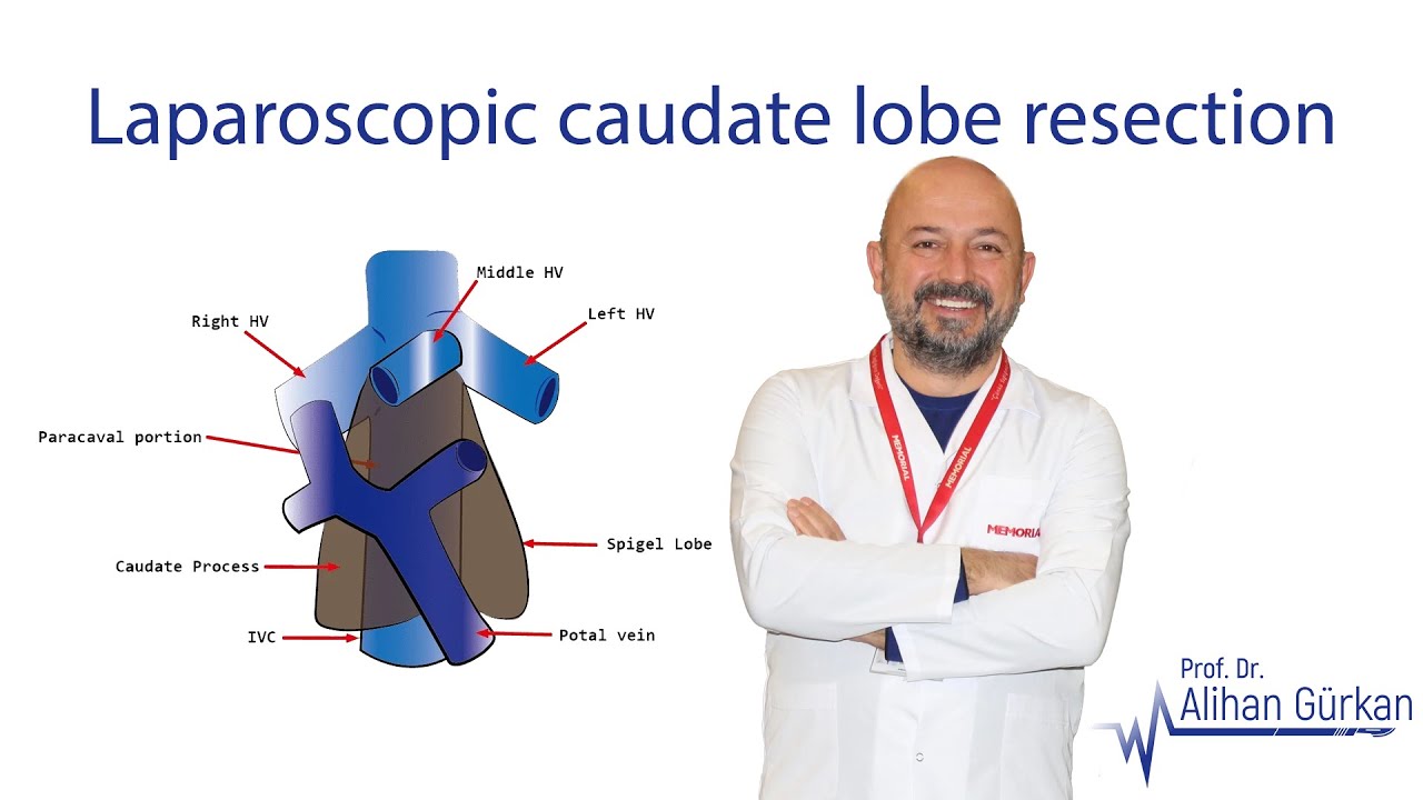 Laparoscopic caudate lobe resection ameliyatı ile Ukraynalı model kanserden Türkiye'de Kurtuldu