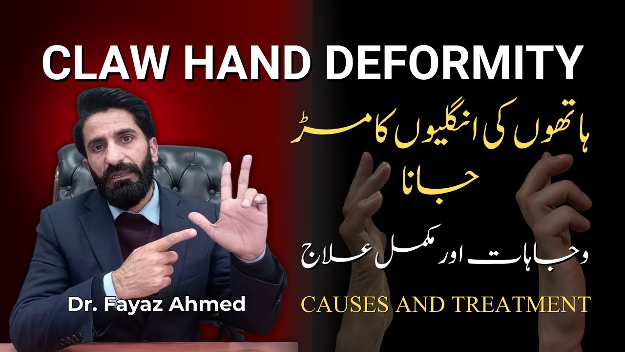 Claw Hand Deformity: Causes, Signs, Symptoms, and Effective Treatment Options