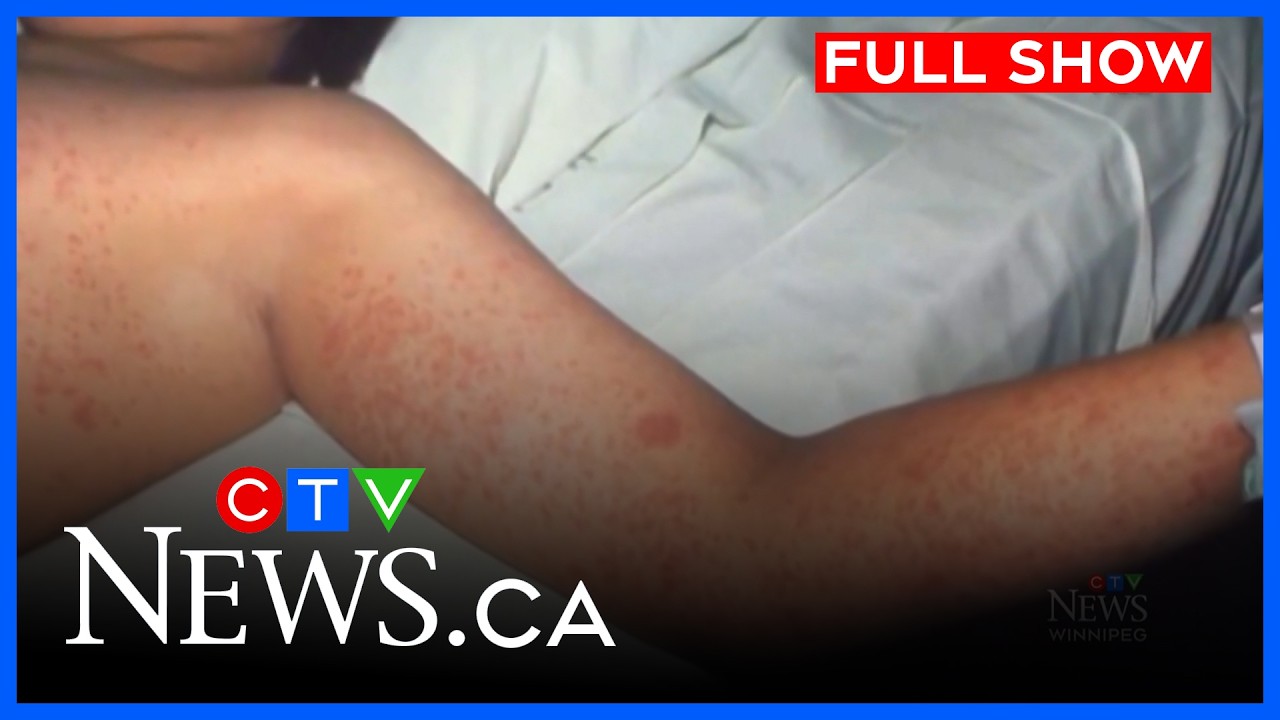 Manitoba records 170 measles cases in February | CTV News Winnipeg at Six for Mar. 9, 2026