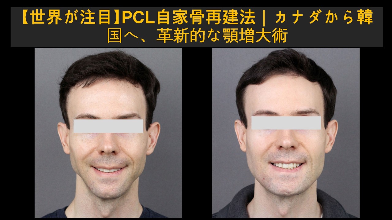 【世界が注目】PCL自家骨再建法｜カナダから韓国へ、革新的な顎増大術