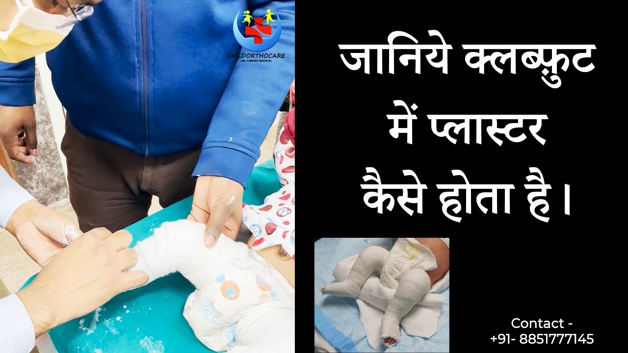 Learn how to plaster a clubfoot. Clubfoot Treatment
