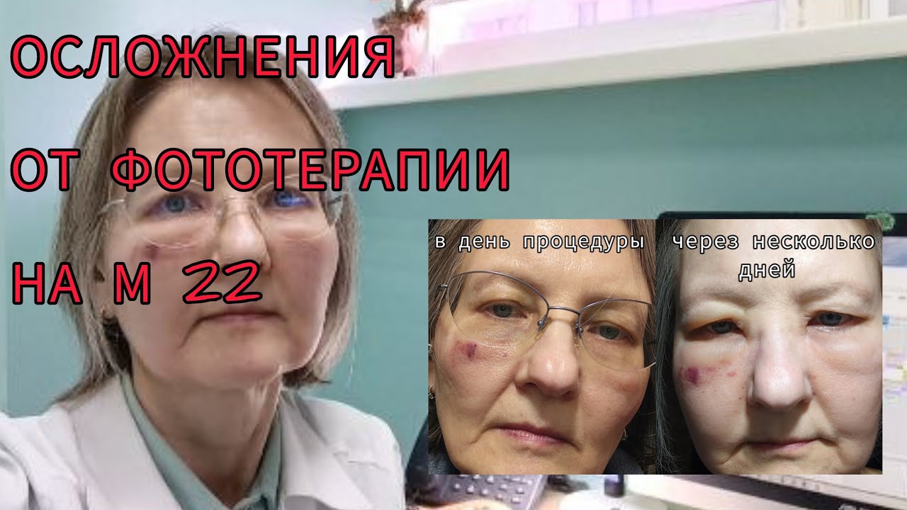 Отек века и синяк под глазом: осложнения от фотоомоложения на аппарате М 22 или так реагирует атопик