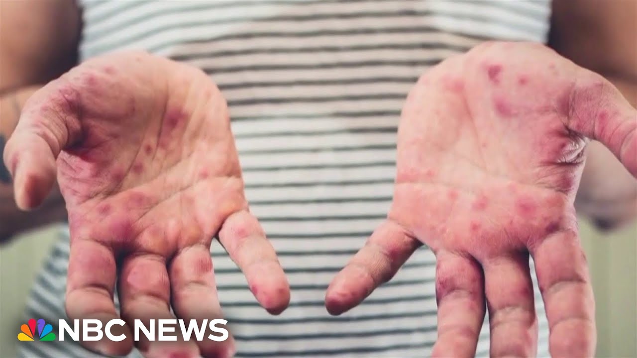 Texas measles outbreak explodes to nearly 500 cases