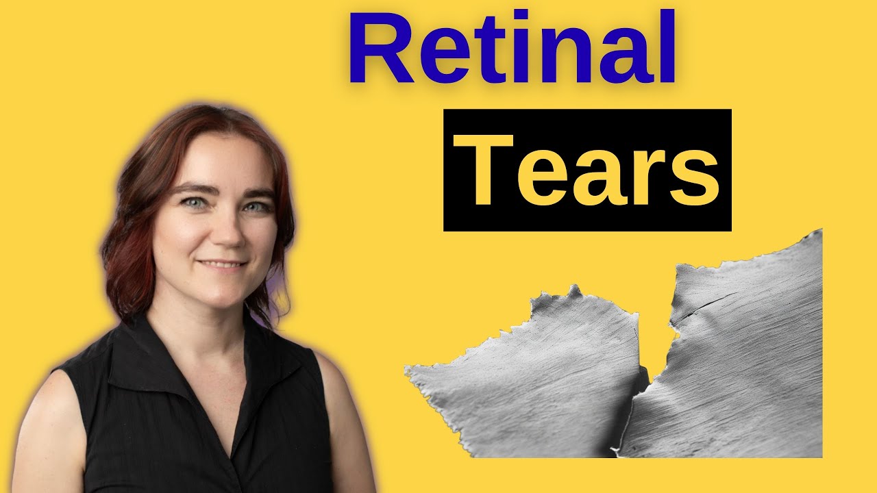 Retinal Tears - A Retinal Surgeon Explains