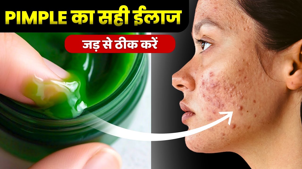 बस ये करलो 10 साल पूराने पिम्पल और कील मुहासे भी ठीक होजाएंगे  😊