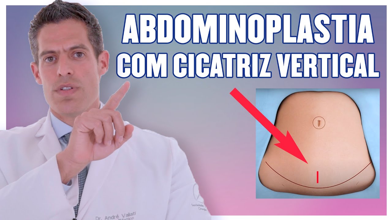 Abdominoplastia com cicatriz vertical